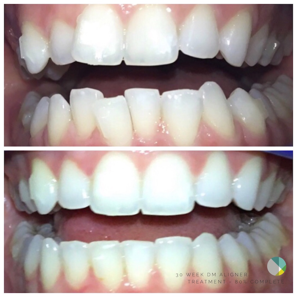 DM Clear Aligners DM Clear Aligners